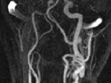 Neuwelt:  Ferumoxytol CE MR Angiography of the supra-aortic arteries (click to enlarge)