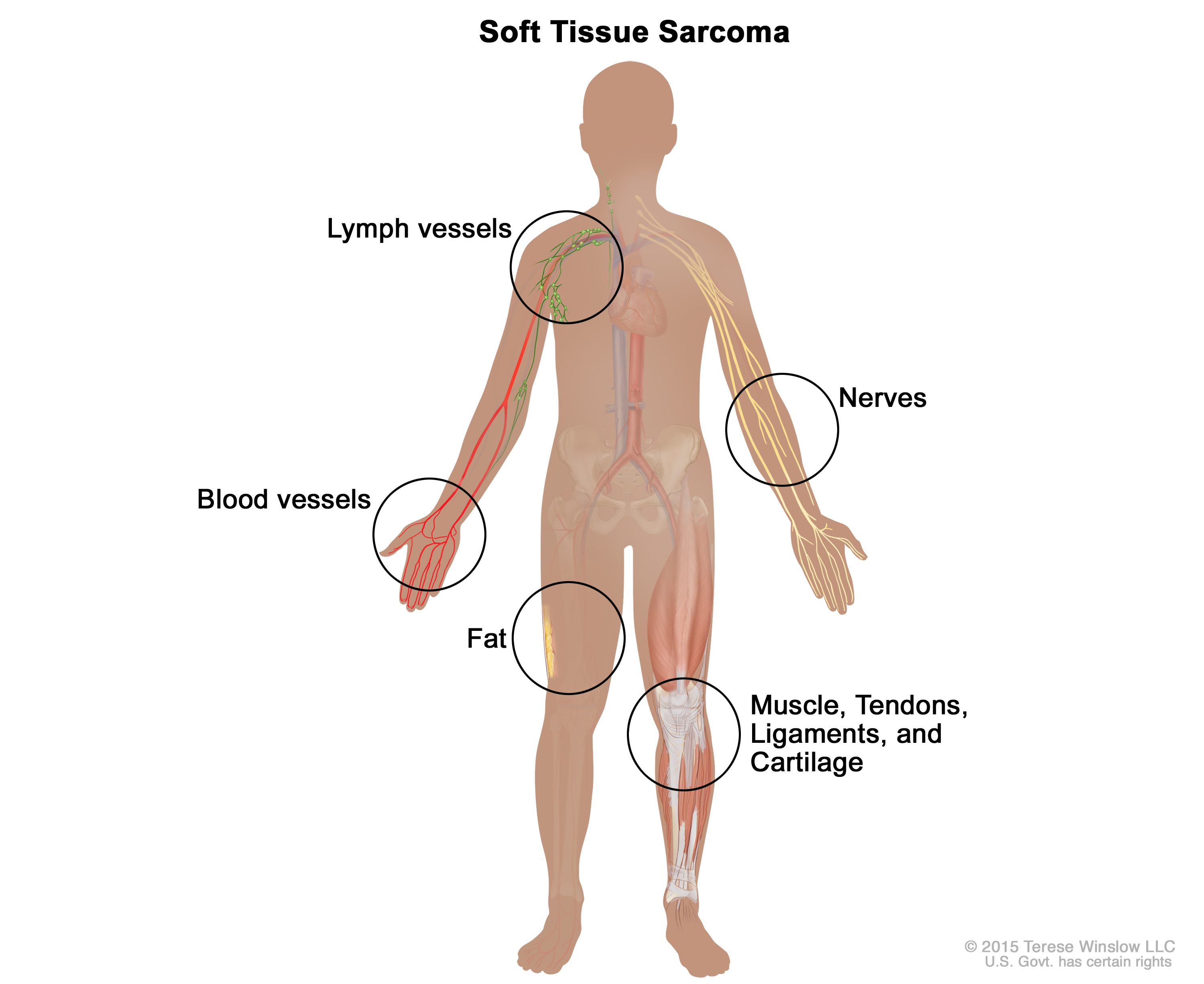 Soft tissue sarcoma