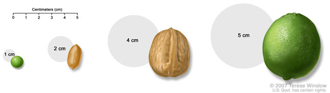 Medical Illustration of Tumor Sizes compared to everyday items, including a pea, a peanut, a walnut, and a lime