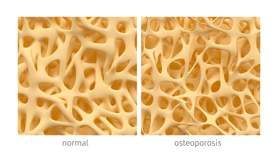 Simulated magnified normal versus osteoporotic bone