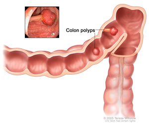 A drawing shows a section of colon with two small clumps of abnormal tissue inside called polyps. Left untreated, polyps in the colon can turn into cancer.