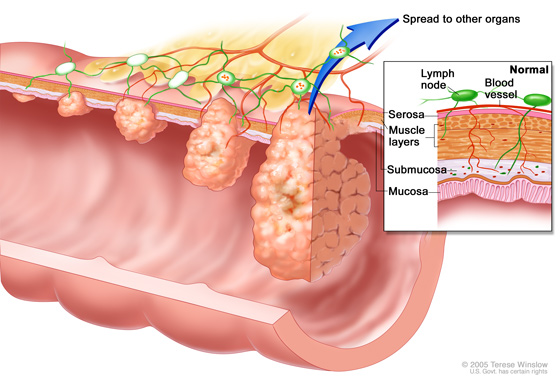 Colorectal tumor sizes, which also correspond to cancer stages. Inset box showing inner to outermost layers of the colon including: mucosa, submucosa, muscle layers, and serosa.
