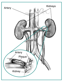 Illustration of renal artery disease showing plaque buildup in arteries.