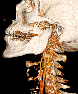 CTA of the Head and Neck image A for Radiology 