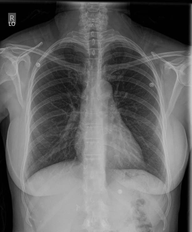 Normal Chest X-Ray for Radiology