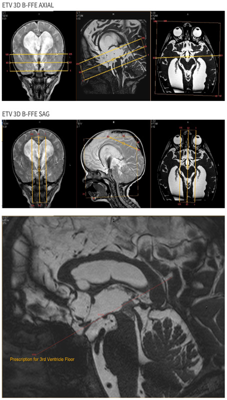 MR Brain ETV WO Neuro Protocol image