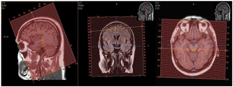 MR Protocol Epilepsy Seizure Brain for Ingenia in Radiology