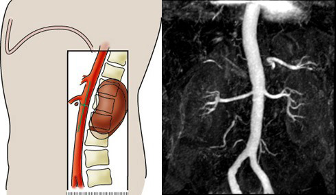 MR Renal Arterial Stenosis protocol - Scanning for Coronal 3D mDixon