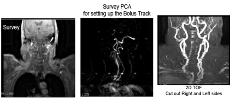 MRA Neck WWO Neuro Radiology Protocol image 2 showing MR Techs where to trigger the bolus track