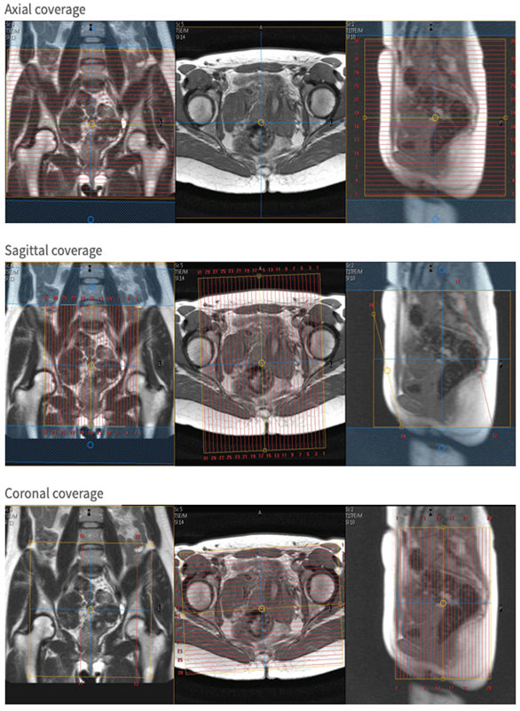 MRI Placenta WO BODY Protocol image