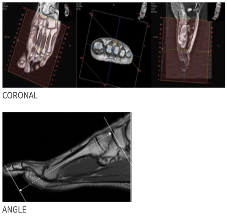 MRI Toe_Foot MSK Protocol image 3