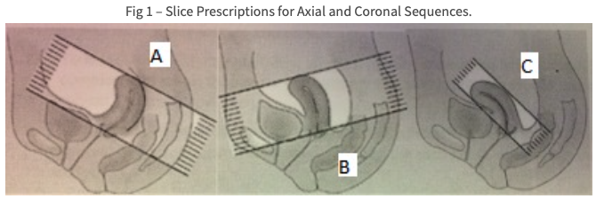 MR Bayer Asteroid Research Protocol Image Fig. 1- Slice prescriptions for Axial and Coronal sequences