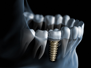 State-of-the-Art Dental Implants at the OHSU Dental Clinics