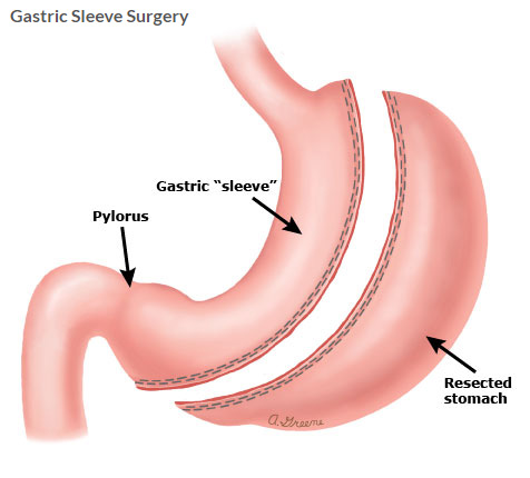 Medical illustration of Gastric Sleeve Surgery