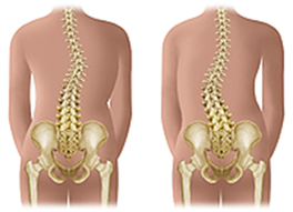 Illustration of lumbar and thoracic scoliosis of the spine