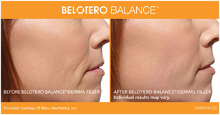 A before and after photo of cosmetic filler Belotero from the side
