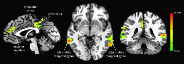 Brain image scan showing three regions of the brain where grey matter density is related to a metabolite