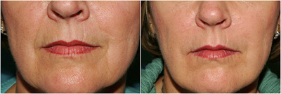 A before and after photo of facial treatments