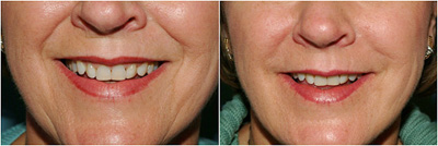 Facial treatments before and after image of lower face results