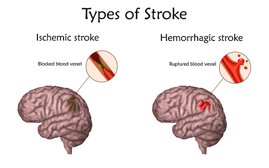 This diagram illustrates the two types of stroke: Ischemic, caused by a blockage; and hemorrhagic, caused by a ruptured blood vessel.