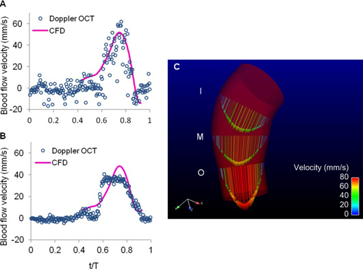 Figure showing blood flow dynamics with two line graphs (labeled A and B) and a computer illustration (labeled C), each presenting measurements of blood flow velocity. 