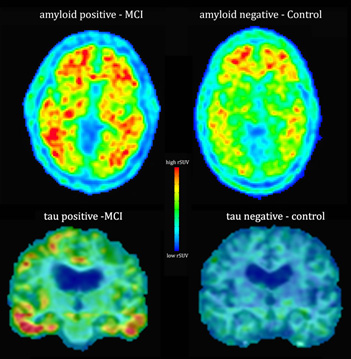 PET scan of the brain showing amyloid plaques and neurofibrillary tangles associated with Alzheimer's disease