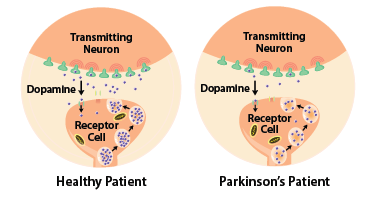 Diagram: Parkinson's patients have less dopamine. Illustration Source: National Institute of Environmental Health Sciences