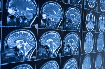 Brain MRI Images on Backlight