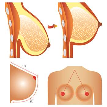 Medical illustration showing the before and after of a breast lift (mammoplasty)