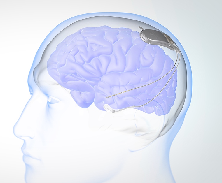 Courtesy of Neuropace. OHSU researchers helped develop an implantable device that prevents or stops seizures - RNS, responsive neurostimulation