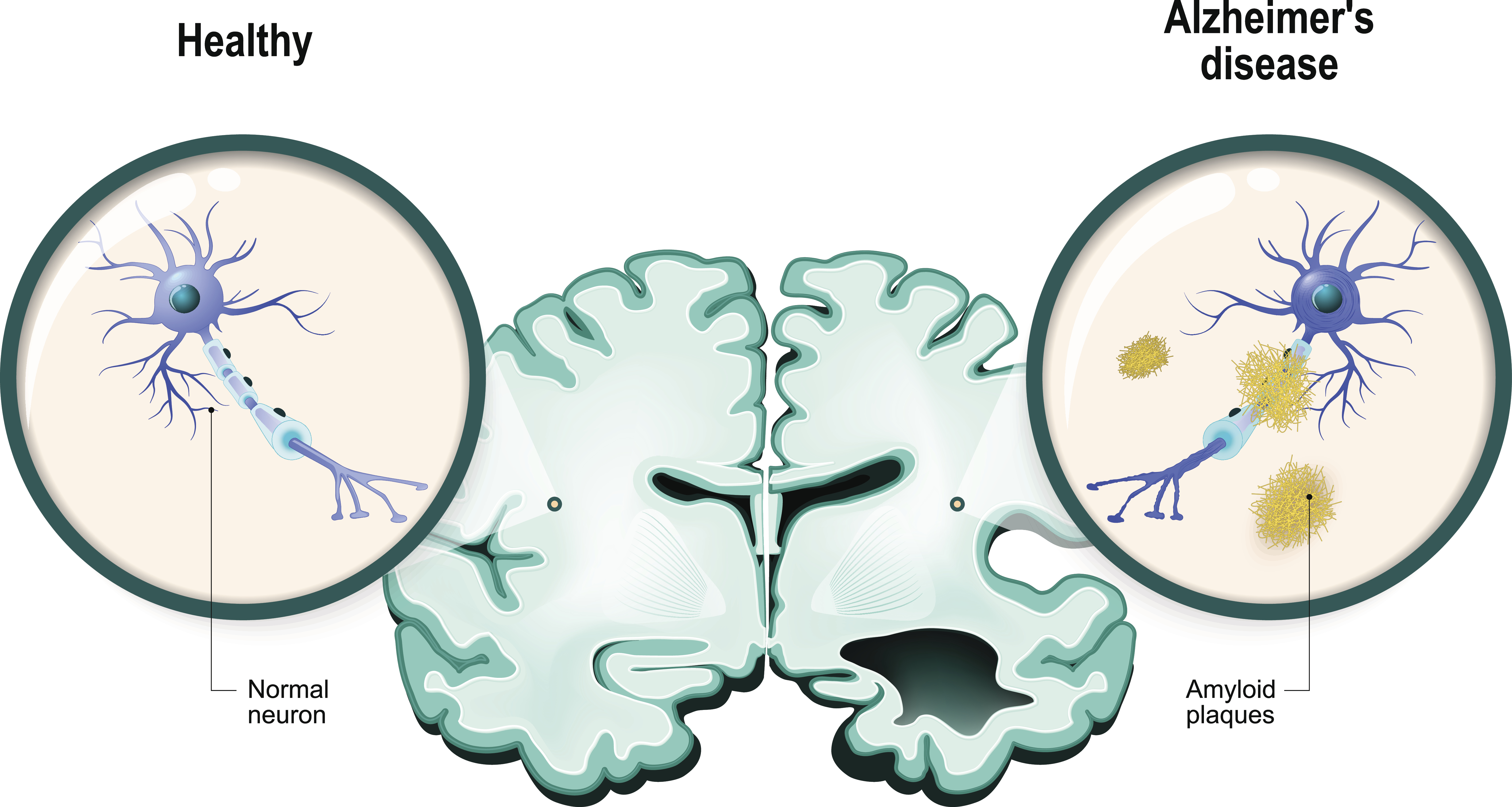 Medical Illustration of brain and neurons: Healthy vs. Alzheimer's disease