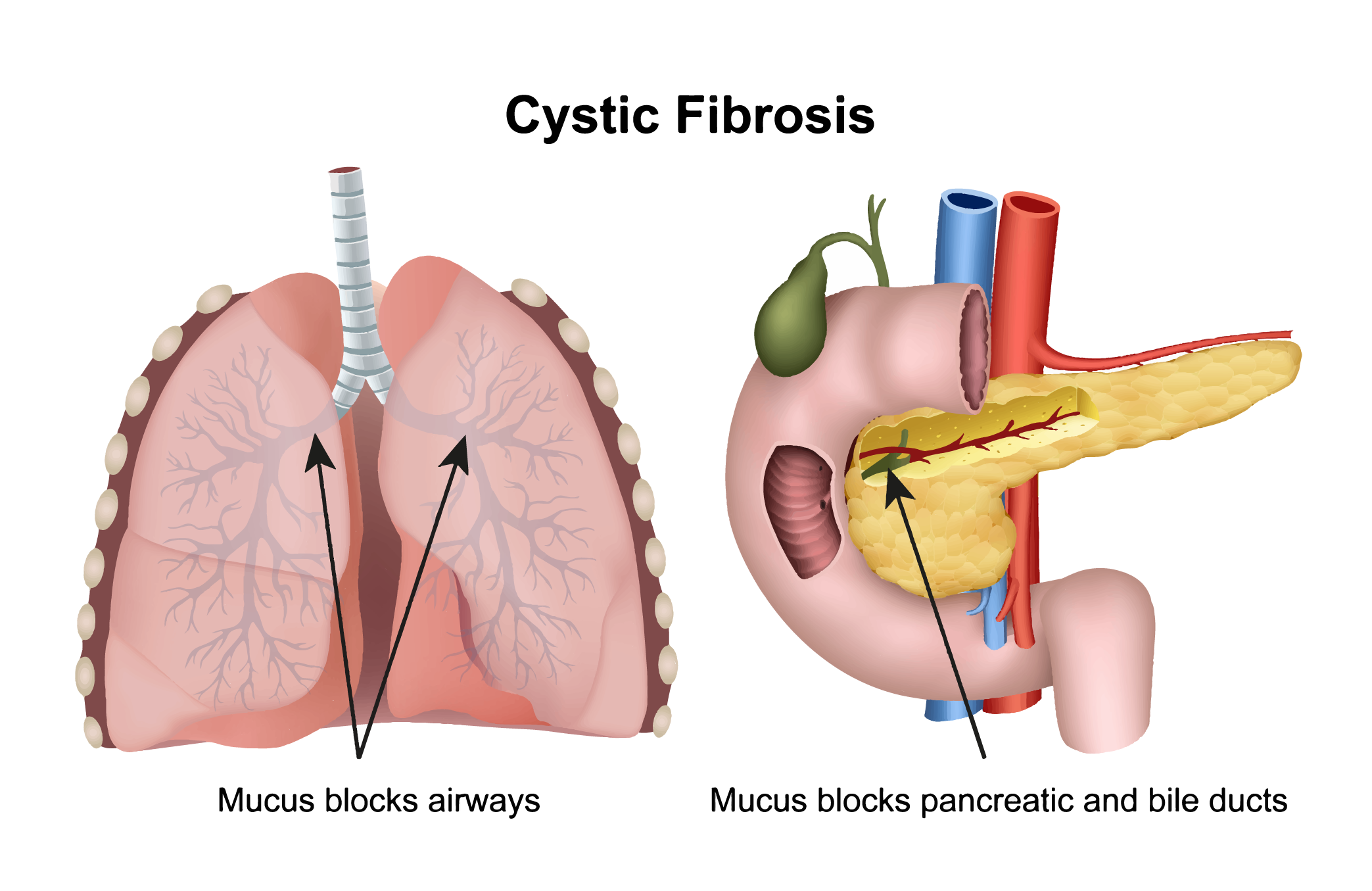 A diagram of the human lungs and pancreas that illustrates mucus blockage in patients with cystic fibrosis.