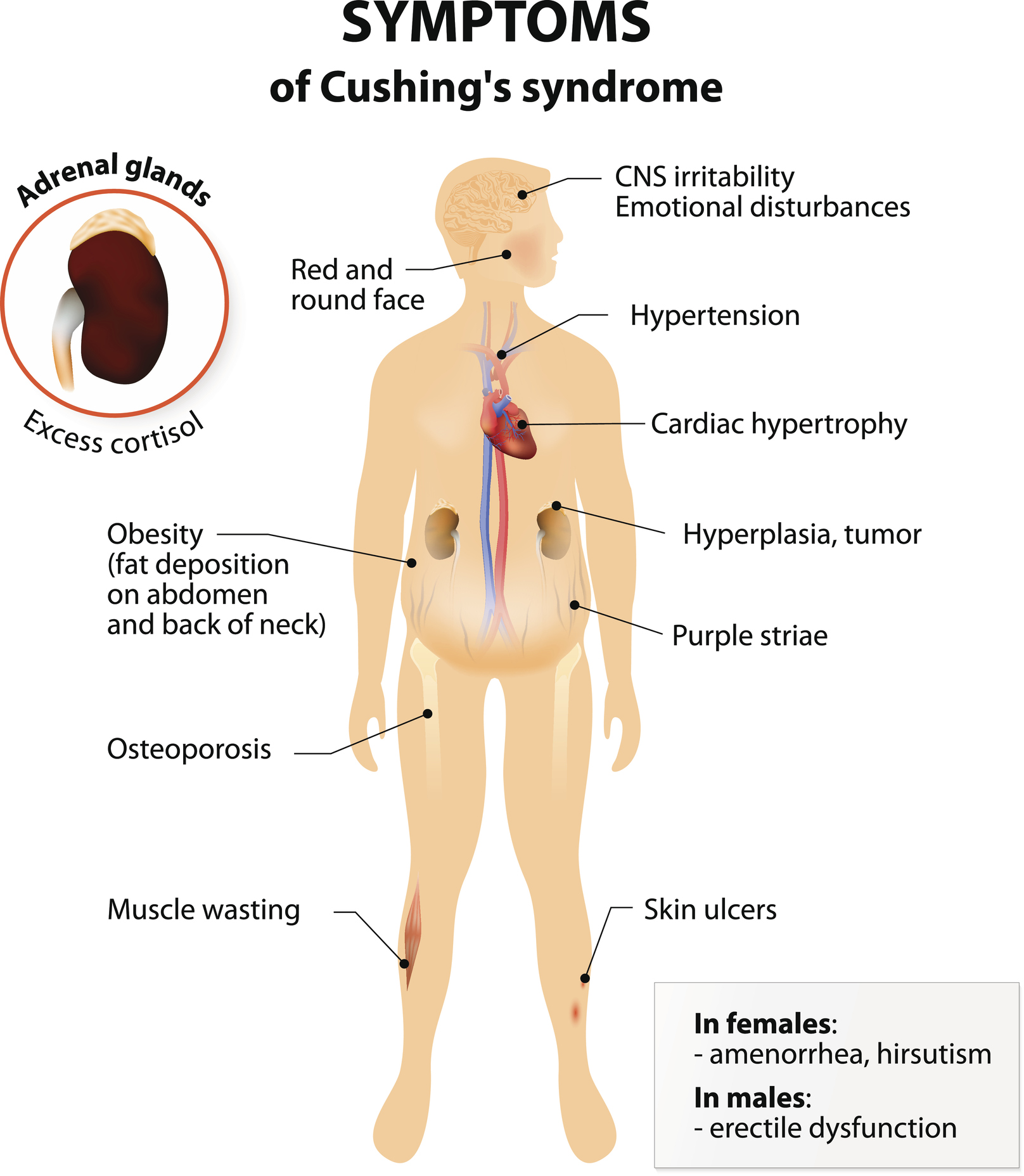 Pituitary Center | Diagram of Cushings Syndrome (Cushing's Syndrome) symptoms