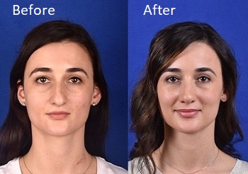 Front facing image of rhinoplasty before and after - female