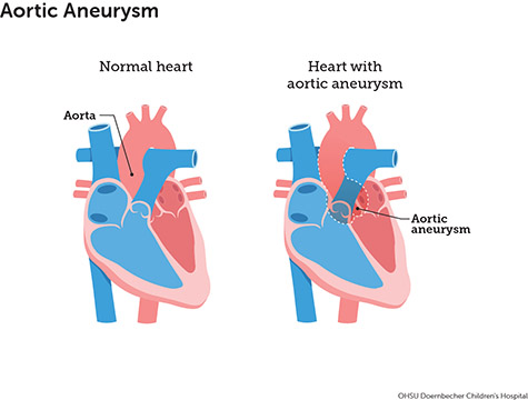 A diagram of two hearts side-by-side, one a normal heart and other a heart with an aortic aneurysm.