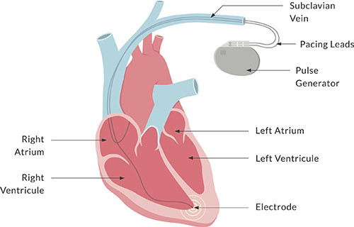 Diagram of a pacemaker and how it connects to the heart