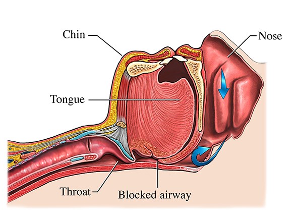 A diagram showing the anatomy of someone with obstructive sleep apnea.