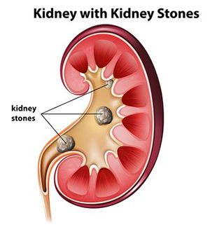 A diagram showing a kidney that has kidney stones.