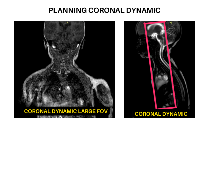 Planning COR Dynamic sequence for vascular access MRI protocol