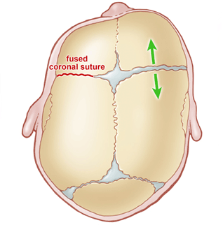 A diagram of an infant's skull with a fused coronal suture.