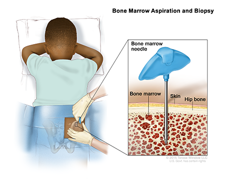 A drawing of a doctor using a bone marrow needle to collect a sample from the back of a child’s hip bone.