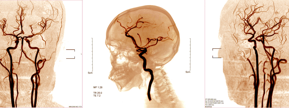 Scan images of blood vessels in the brain.
