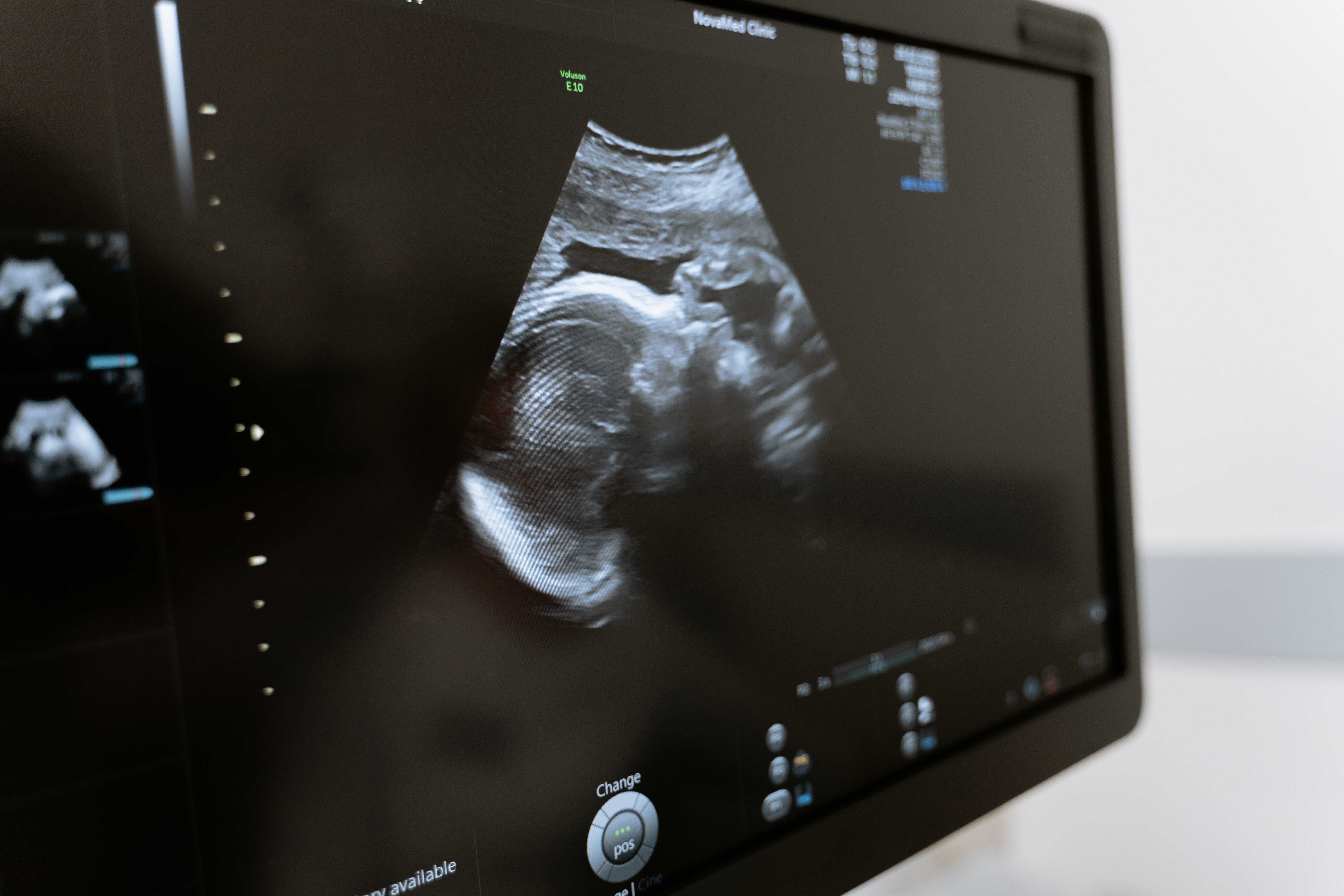 An image displayed on a computer monitor of a baby in-utero during an ultrasound.