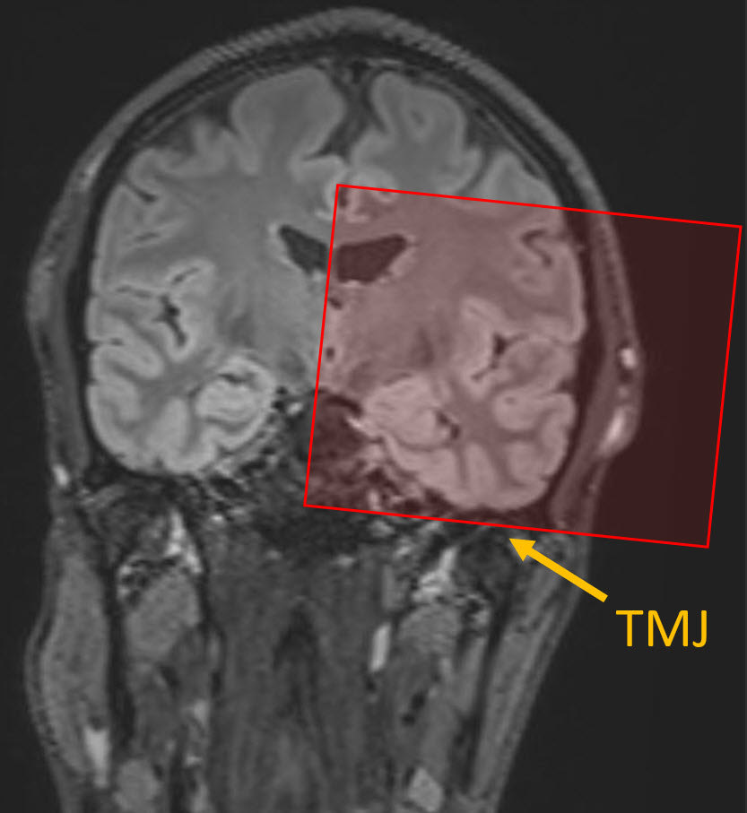 Coronal FLAIR image showing anatomic coverage for this MRI seqeunce.