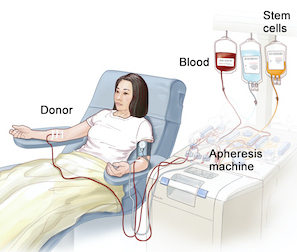 A donor gives blood through an apheresis machine to separate stem cells.