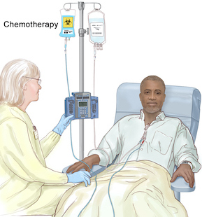 The patient receives chemotherapy to prepare for the donated stem cells.