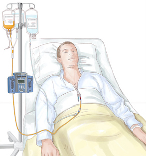 The patient receives the donated stem cells through an IV.