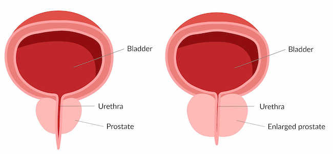 Two diagrams show a typical prostate, and an enlarged prostate pressing on the urethra under the bladder.