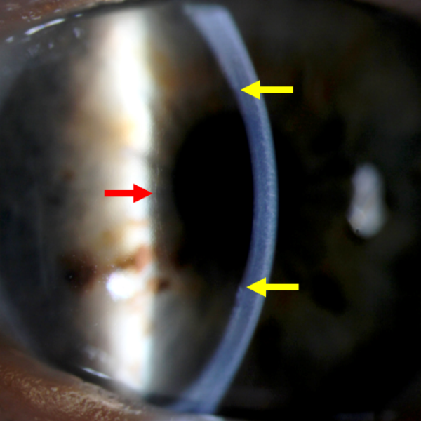 A close image of an eye from the side with three arrows showing areas with a clear cornea.