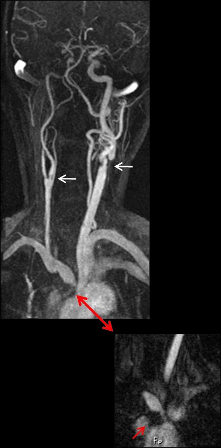 Neuwelt:  Ferumoxytol CE MR Angiography of the supra-aortic arteries